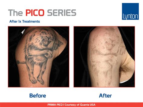 Pico Laser Tattoo Removal Results – Zerkalovulcan