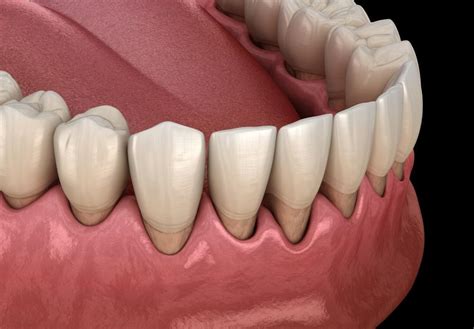 Receding Gums Surgery Before And After