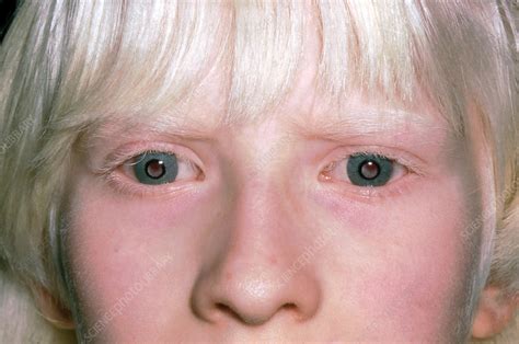 Ocular Albinism Eyes