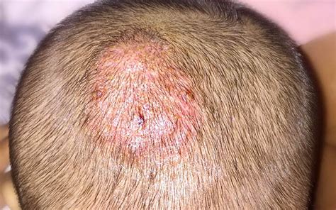 The First Case Report Of Kerion-type Scalp Mycosis Caused By Aspergillus Protuberus BMC ...