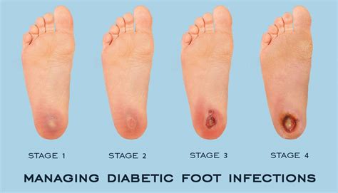 Diabetic Blisters On Legs