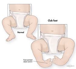 Causes of clubfoot - Our Lucky Foot Journey