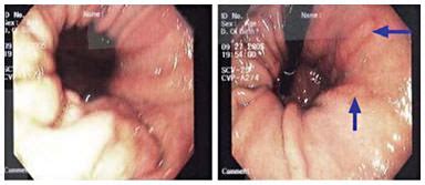 Cameron Lesions: Unusual Cause of Gastrointestinal Bleeding and Anemia ...