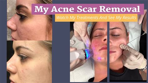 My Acne Scar Removal Journey: RF Microneedling with PRP Treatments and Results - YouTube