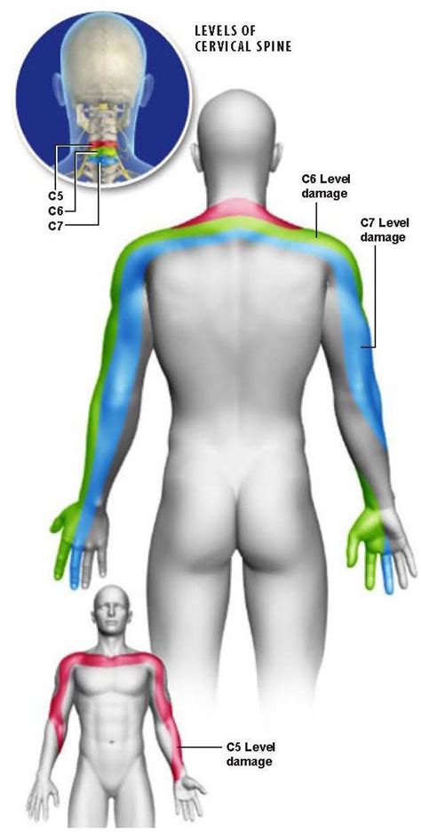 Cervical Radiculopathy - Plano, TX: Advanced Spine Center