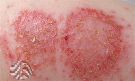 Discoid eczema | NHS inform