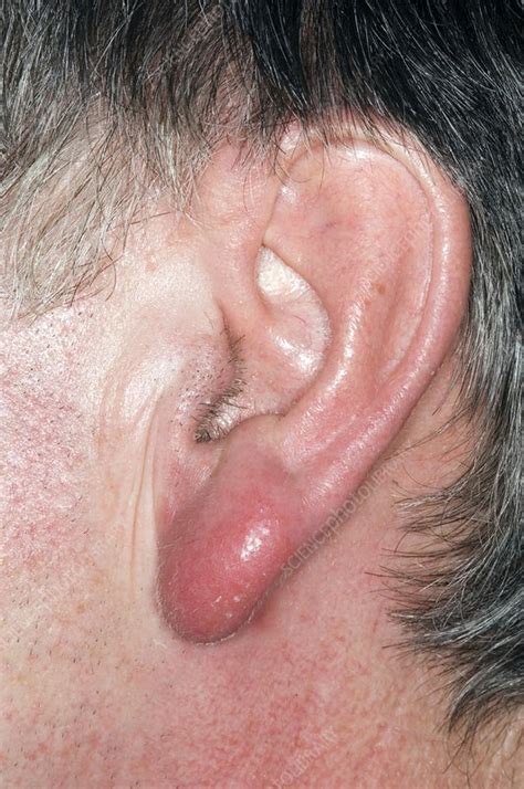 Cellulitis on the earlobe - Stock Image - C004/1219 - Science Photo Library