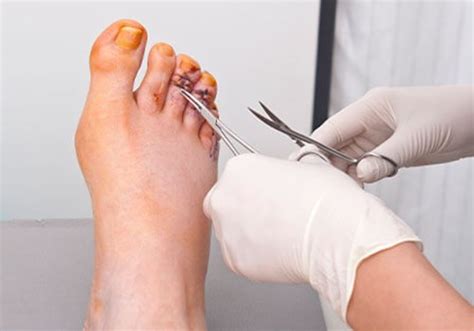 Certified Foot Surgery Facility | Edmonton Foot Clinic