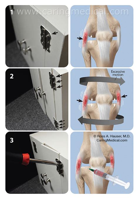 The Hinge-Joint Analogy