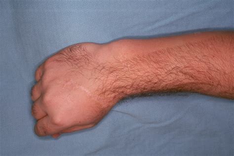 bone sticks out of wrist