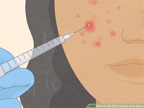 4 Ways to Get Rid of Cystic Acne Scars - wikiHow