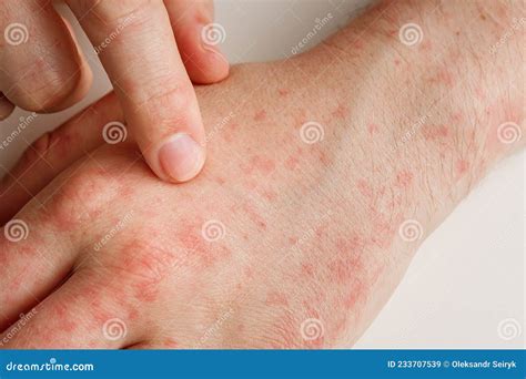 Hands with Allergy Reaction from Taking Medicines. by-effect, Dermatology. Patient Points on Red ...