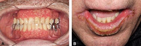 Pyostomatitis vegetans (PSV)-pyodermatitis vegetans (PDV): A clinicopathologic study of 7 cases ...