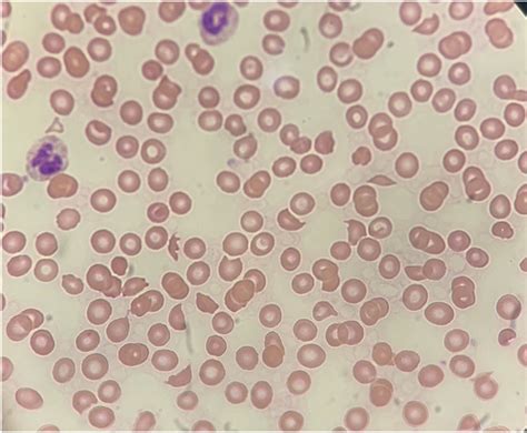 Peripheral blood smear revealing 4+ schistocytes per high power field | Download Scientific Diagram