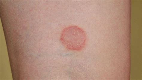 Pityriasis Rosea: Stages, Causes & Treatment - Health Blog