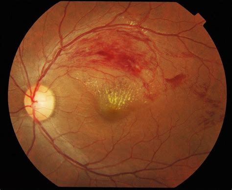 Retinal Vein Occlusion - Ophthalmology - Medbullets Step 2/3