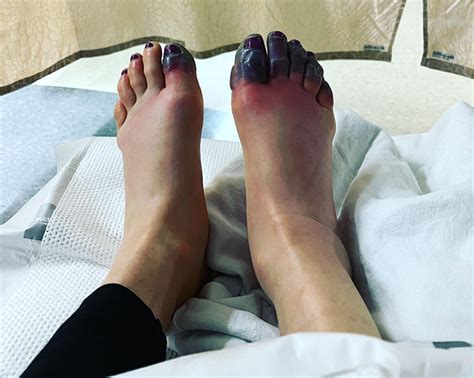 Climber Anna Pfaff to Lose Toes After Frostbite » Explorersweb