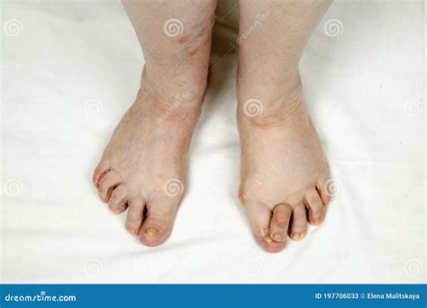 Legs of an Elderly Woman with Rheumatoid Arthritis Stock Image - Image ...