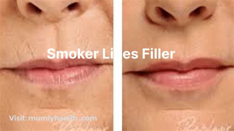 Say Goodbye to Smoker Lines: Discover the Perfect Filler for a Youthful ...