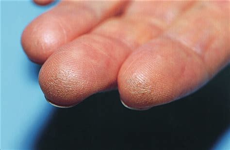 A Callused Clue Fingers the Diagnosis | Dermatology | JAMA Neurology ...