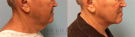 Male T-Z-Plasty Before & After Photos Patient 505 | The Woodlands, TX ...