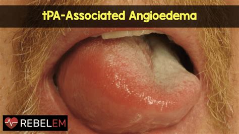 tPA-Associated Angioedema - REBEL EM - Emergency Medicine Blog