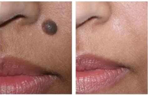 Laser Mole Removal for Facial Mole Removal or Cosmetic Mole Removal