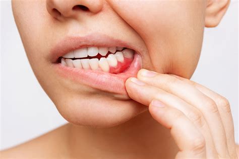 Swelling in My Gums - What Does it Mean?