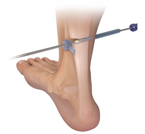 Arthrex - Endoscopic Gastrocnemius Recession