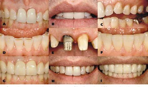 Figure 2 from Interdisciplinary management of anterior dental esthetics ...