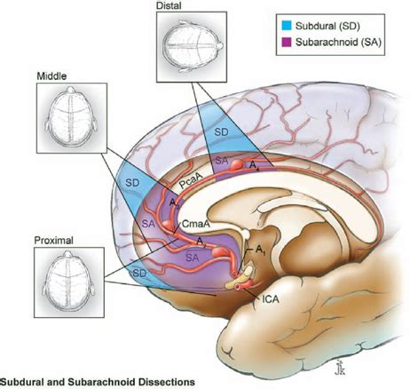 Pericallosal Artery Aneurysms | Neupsy Key