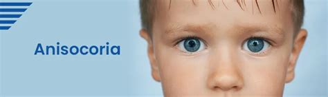 Test for Anisocoria Symptom | Sprint Diagnostics Hyderabad