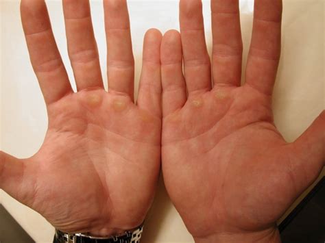 What Causes Lump to Appear in Your Palm? | Med-Health.net