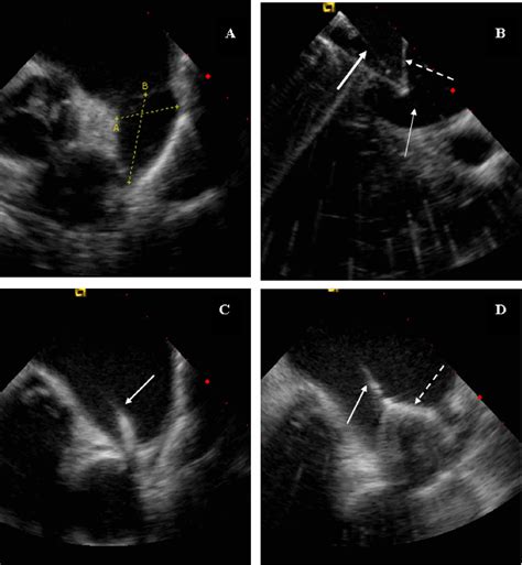 Use of intracardiac echocardiography to guide implantation of a left atrial appendage occlusion ...