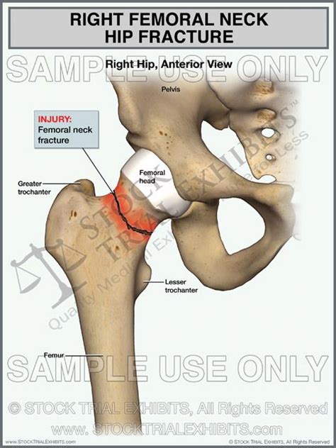 Right femoral neck hip fracture stock medical image, reusable medical illustration | Упражнения ...