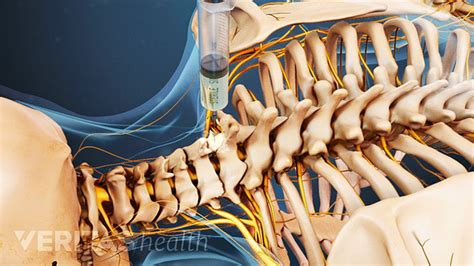 How Cervical Selective Nerve Root Blocks Can Ease Neck Pain