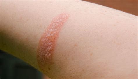 2nd-Degree Burn: What It Looks Like, Treatment & Healing