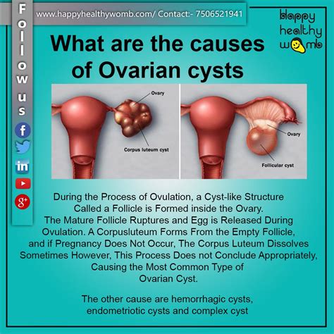 WHAT ARE THE CAUSES OF OVARIAN CYSTS | by Dr. Deepali Lodh | Medium