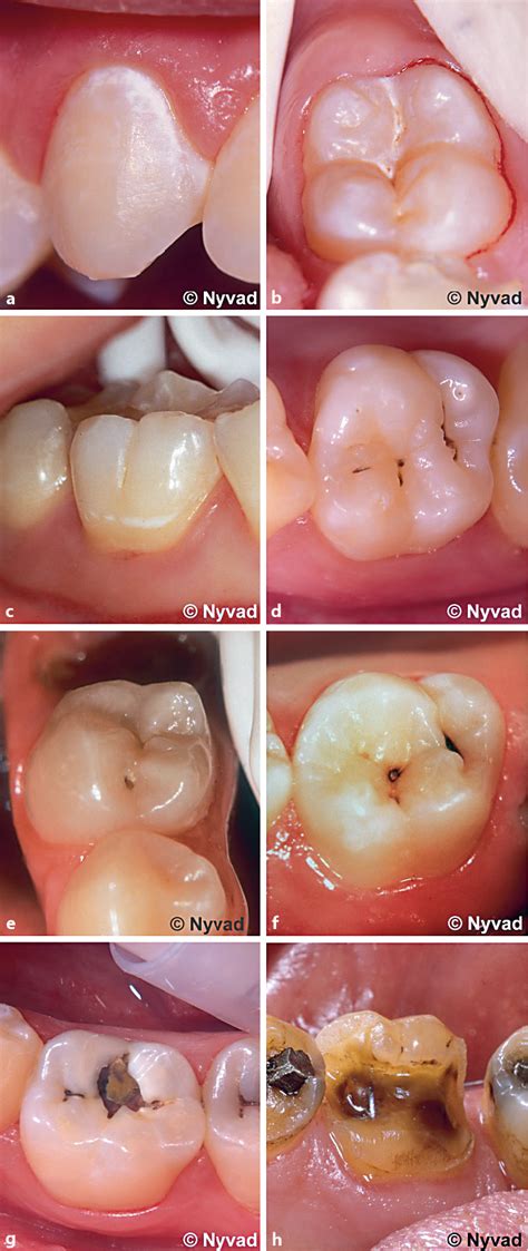 Nyvad Criteria for Caries Lesion Activity and Severity Assessment: A Validated Approach for ...