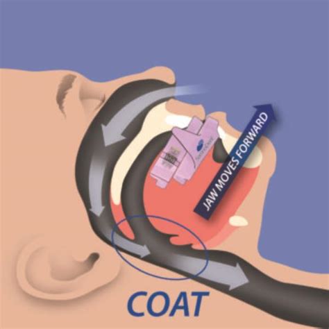 SomnoDent - Doctor Fitted Sleep Apnea Mouthpiece (Updated 2018)