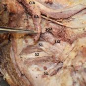 The Relationship between the Superior Gluteal Artery and Lumbosacral Plexus