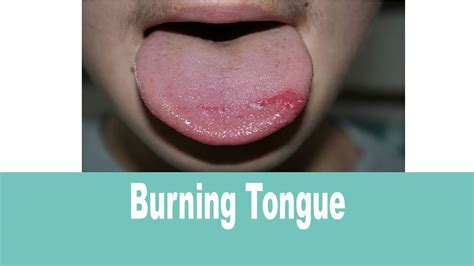 Burning Tongue Syndrome - Causes, Sensation, and Treatment