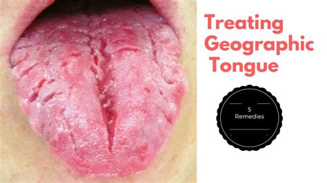 Top 5 Home Remedies for Treating Geographic Tongue - YouTube