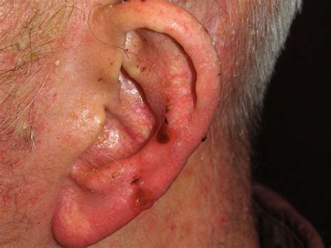 Squamous and Basal Cell Carcinoma Surgical Margins