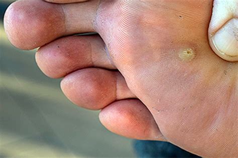 Picture Of Wart On Bottom Of Foot Clearance | emergencydentistry.com