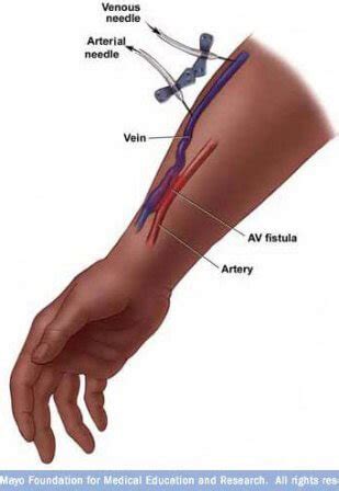 Dialysis access surgery fistula and grafts | San Francisco Vein Center