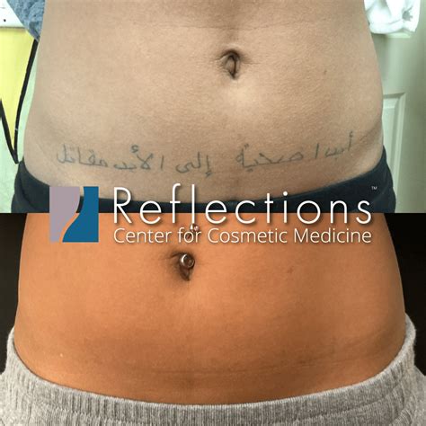 Before And After Tattoo Removal