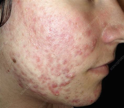 Acne vulgaris - Stock Image - C021/3444 - Science Photo Library