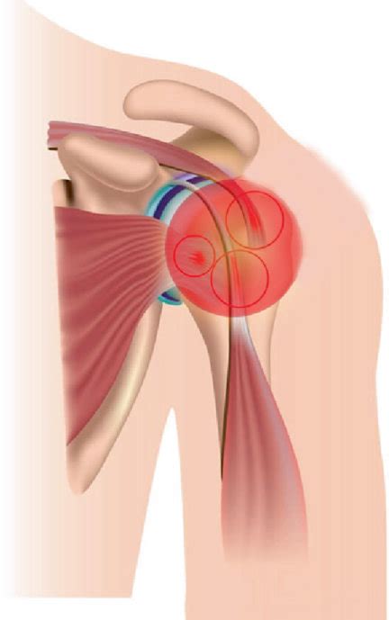 Major tendon injuries: (a) tendonitis, inflammation and irritation of... | Download Scientific ...