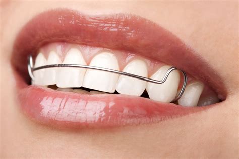 Teeth Retainers After Braces - Usage, Benefits, and Care Tips